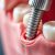 Implantologia stomatologiczna – co warto wiedzieć o implantach?